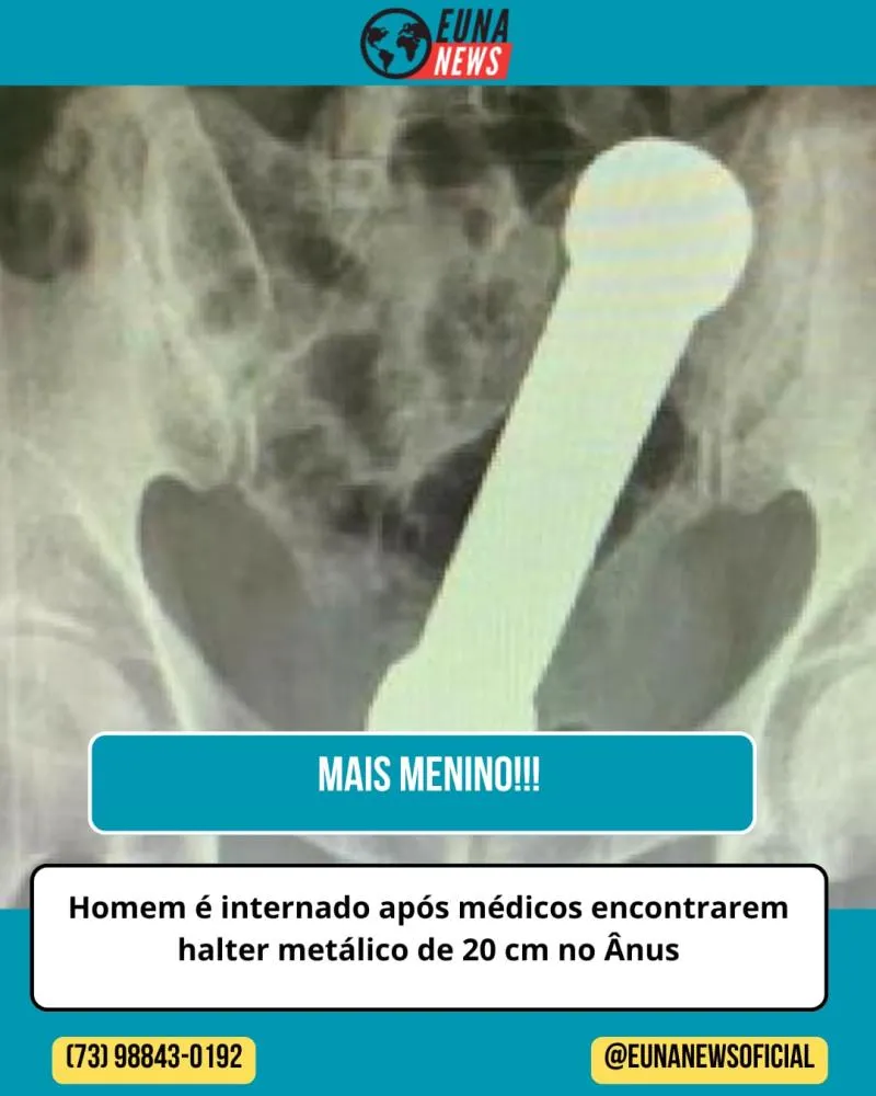 Homem é internado após médicos encontrarem halter metálico de 20 cm no reto